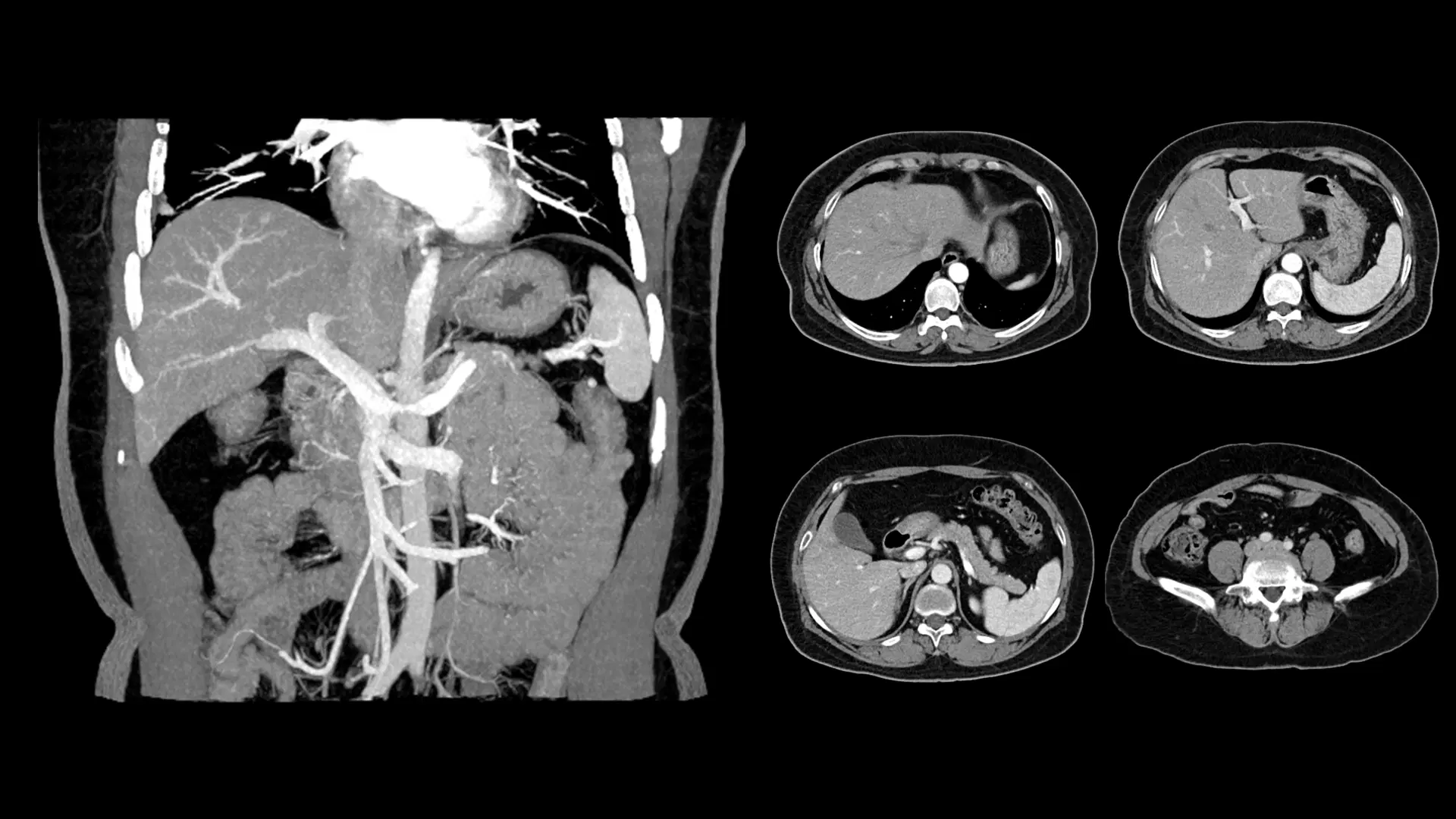 Sample Abdomen CT Scan